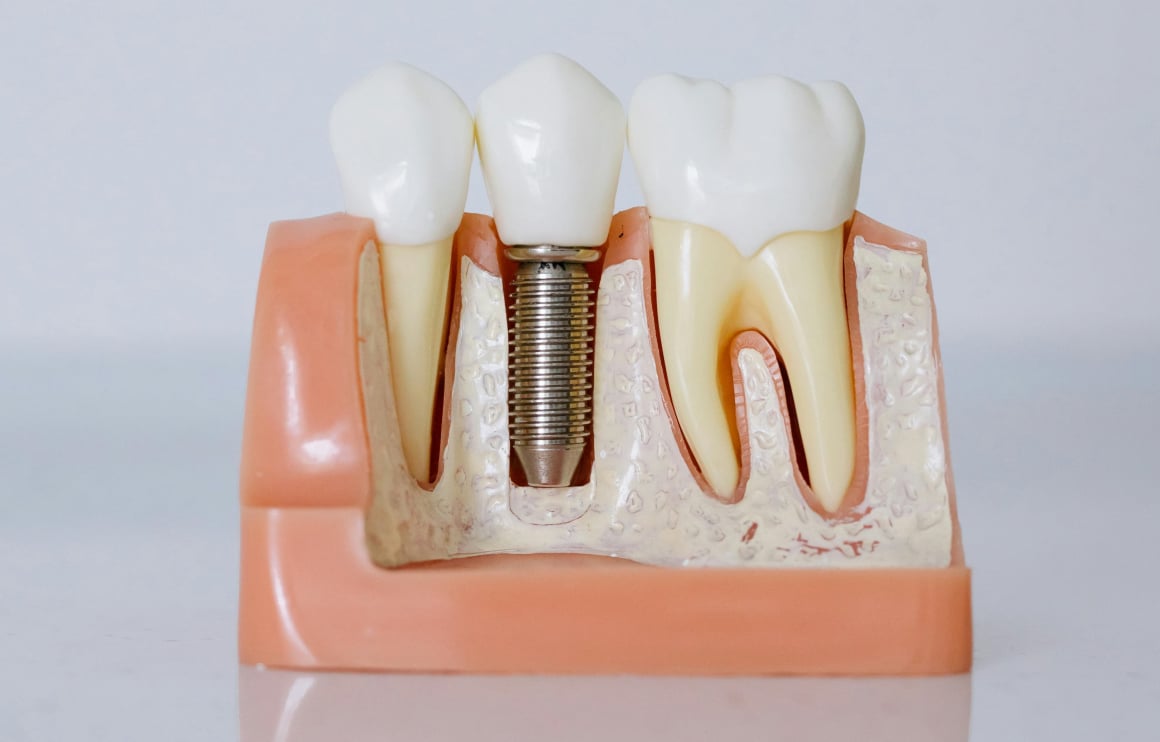 Dental Implant example